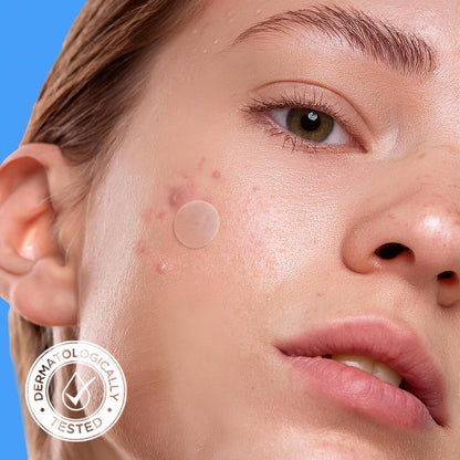 Avarelle Acne Cover Patches | Hydrocolloid Pimple Patches with Tea Tree, Cica & Calendula – Vegan, Cruelty-Free Korean Skincare Zit Patches